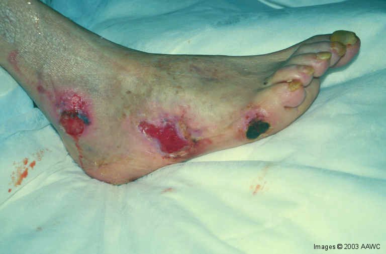 WOUNDS: How to Distinguish Arterial, Venous and Other Ulcers