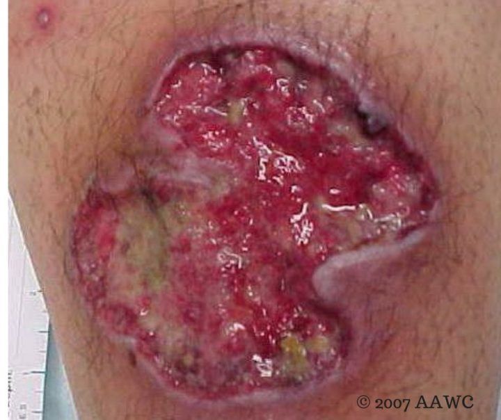 pyoderma gangrenosum images