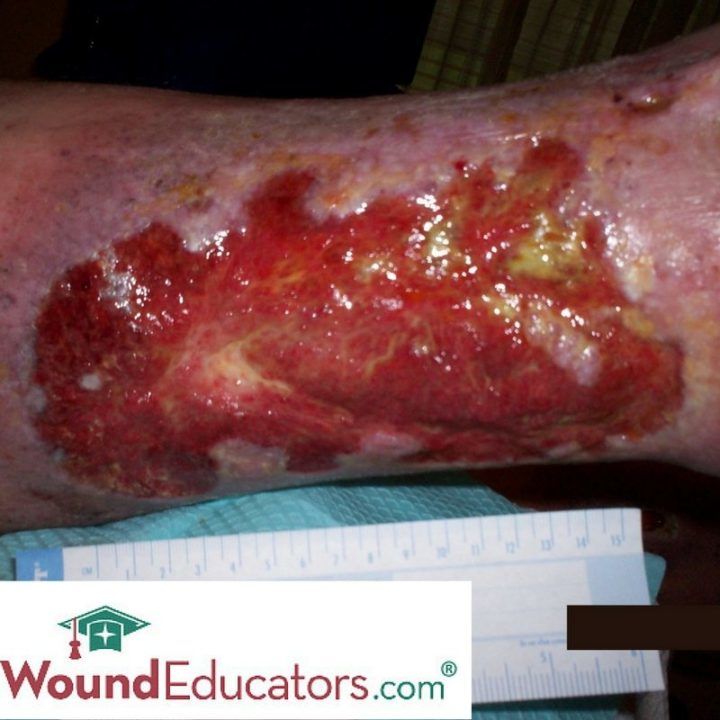 Ulcers Images, Pictures & Photos - CrystalGraphics