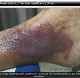 venous stasis causes and treatment