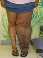 Unilateral lymphedema