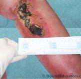 wound infection