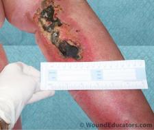 local factors affecting wound healing