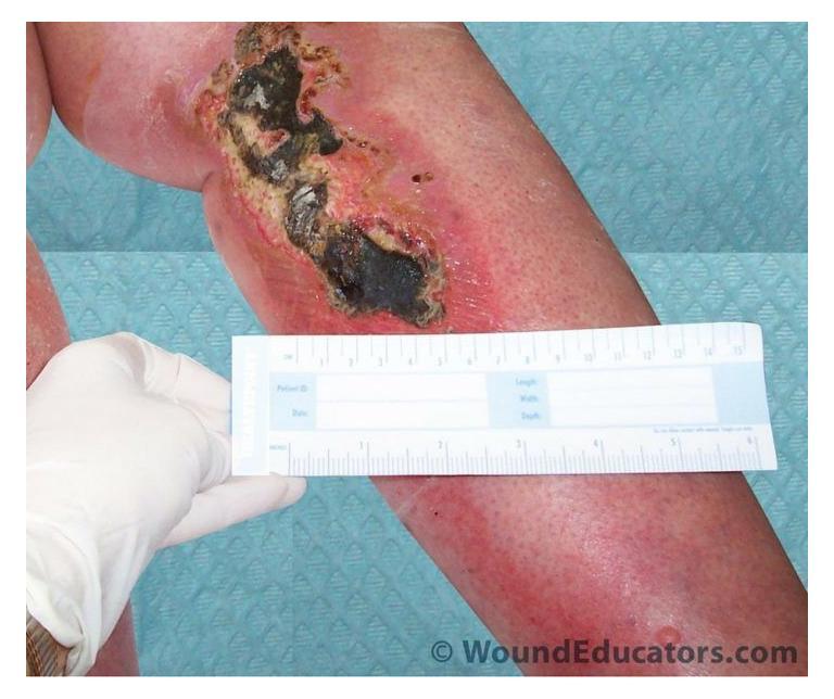 Signs of Wound Infection That Everyone Should Know