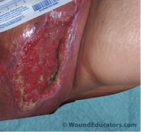 calciphylaxis 4