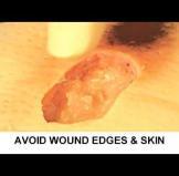 enzymatic wound debridement techniques wound management