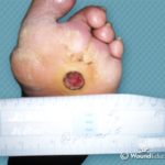 Treatment of Diabetic Foot Ulcers
