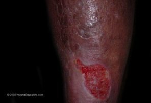 Lower Extremity Ulcers