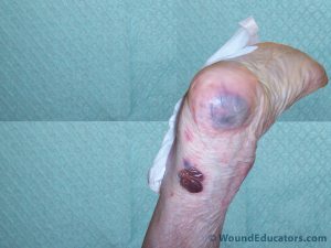Deep Tissue Injury Example