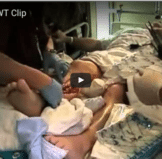 wound vac video wound vaccuuum wound care education