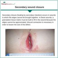 secondary wound closure