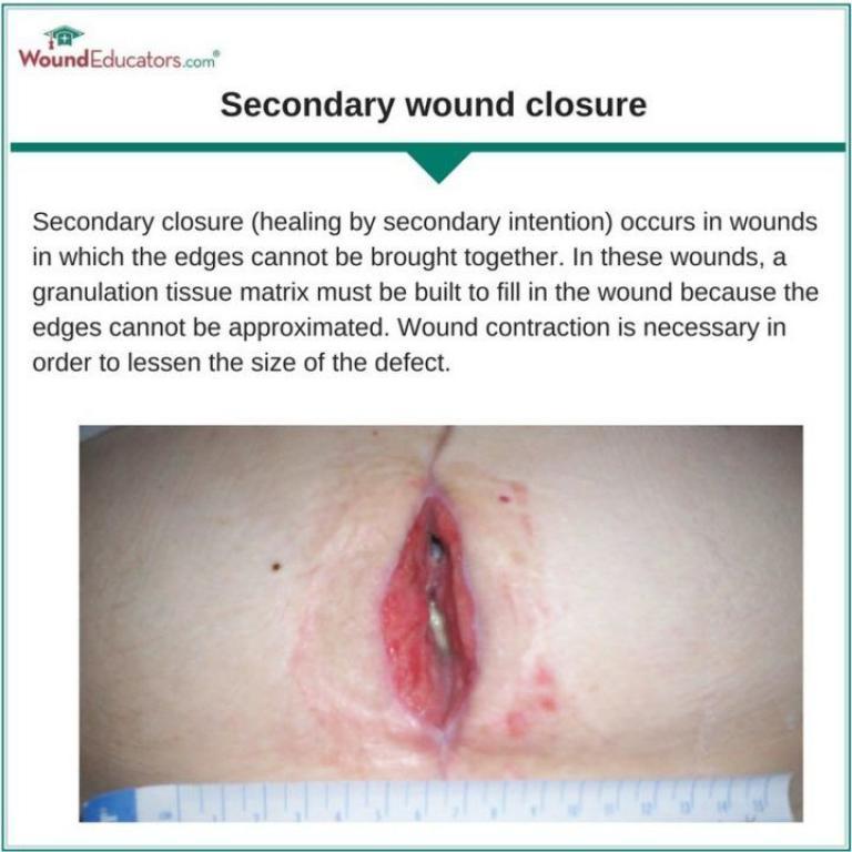 Types of Wound Closure