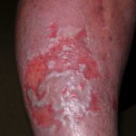 Wound Assessment: Assessing the Periwound and Surrounding Skin