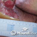 Skin and Periwound Care- Part 1