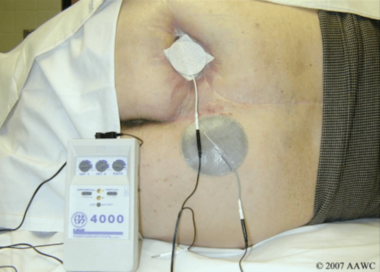 Modalities Utilized in Wound Healing: Electrical Stimulation