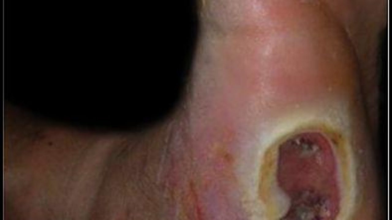icd 10 diabetic foot ulcer with osteomyelitis cukorbetegség hidegfront