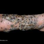 Skin Lesions Due To Malignant Melanoma