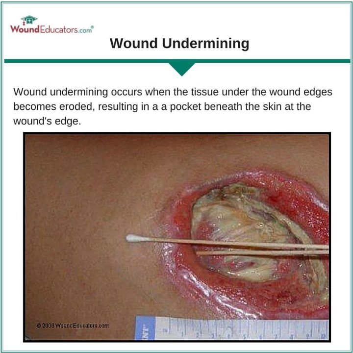 wound undermining wound care education
