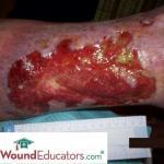 Venous Insufficiency Ulcers – Characteristics