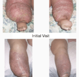 lymphedema before and after care