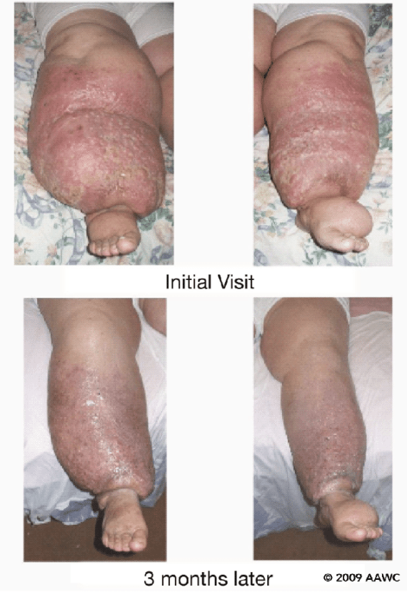 Lymphedema - Wikipedia