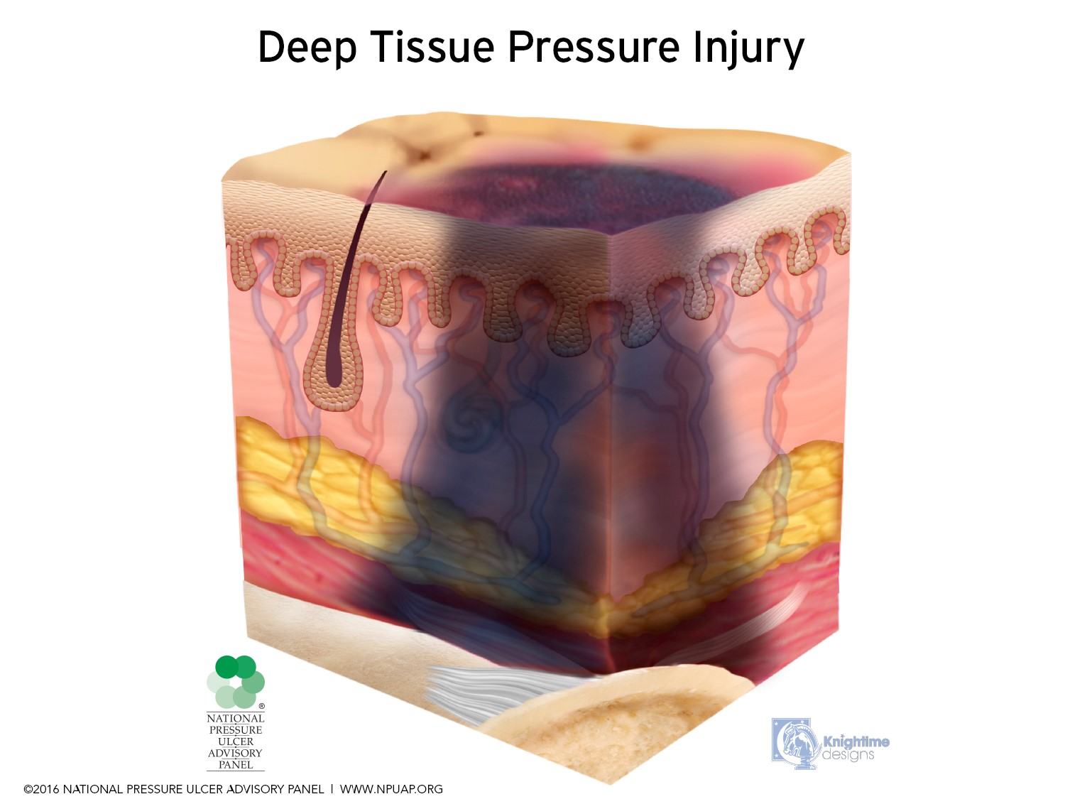 What Is Deep Tissue Injury