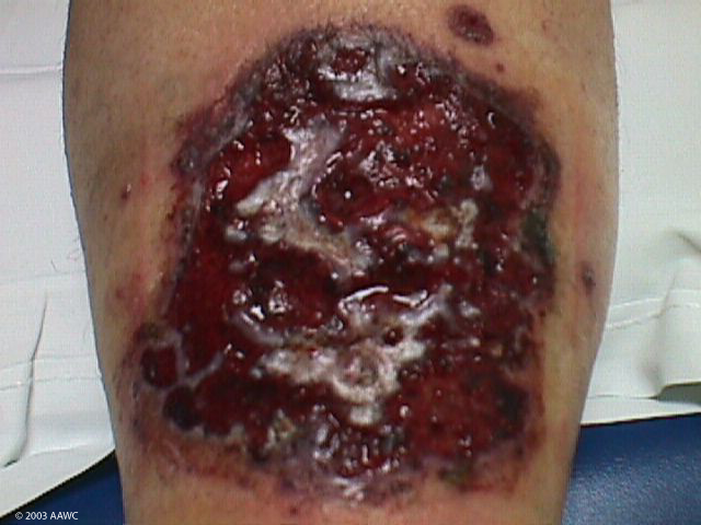 purulent drainage in wound